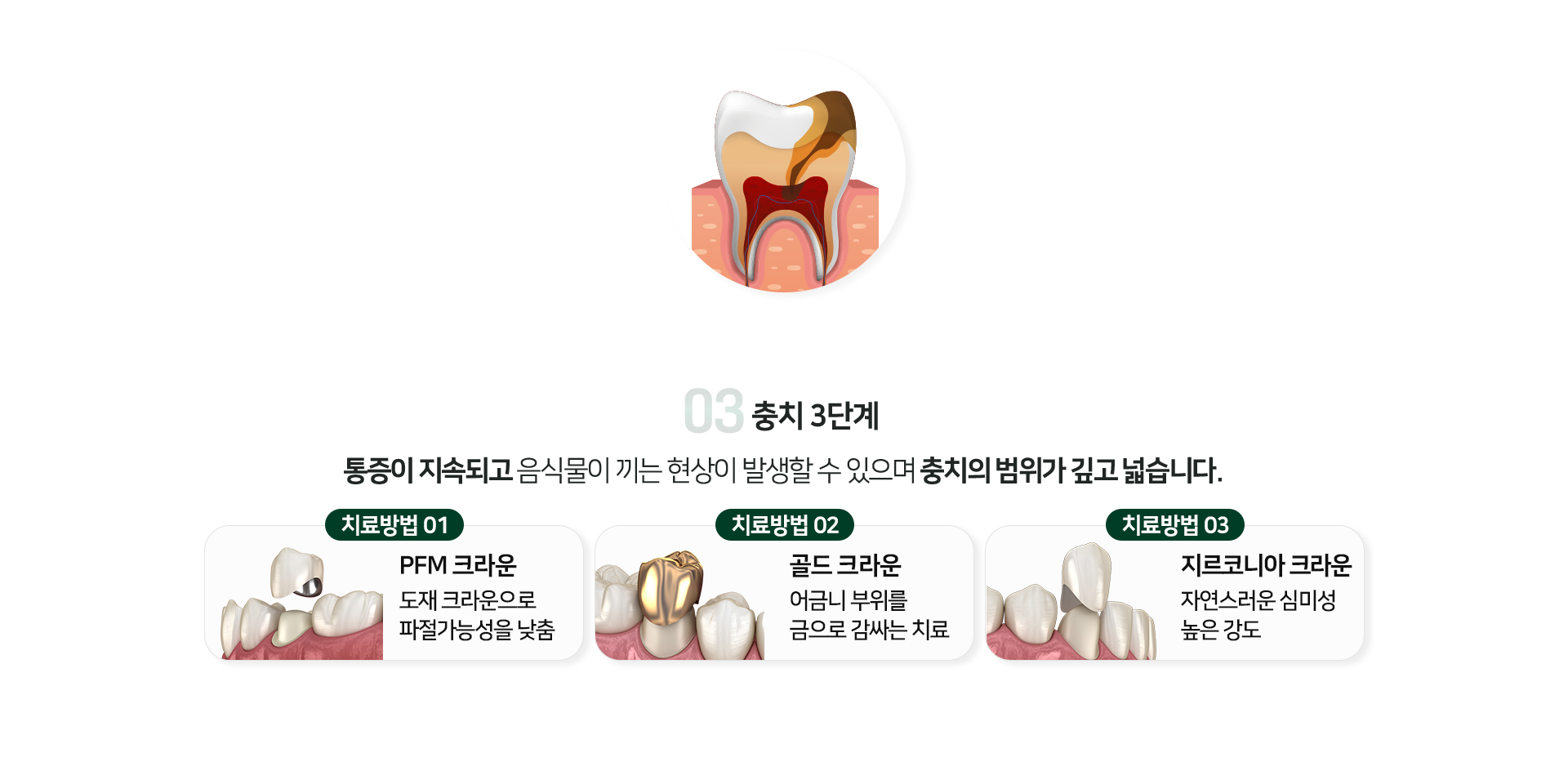 충치-3단계-통증이-지속되고-음식물이-끼는-현상이-발생할-수-있으며-충치의-범위가-깊고-넓습니다-치료방법1-PFM-크라운-도재-크라운으로-파절-가능성을-낮춤-치료방법2-골드-크라운-어금니-부위를-금으로-감싸는-치료-치료방법3-지르코니아-크라운-자연스러운-심미성-높은-강도