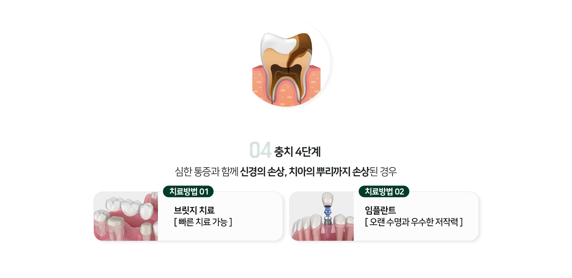 충치-4단계-심한-통증과-함께-신경의-손상-치아의-뿌리까지-손상된-경우-치료방법1-브릿지-치료-빠른-치료-가능-치료방법2-임플란트-오랜-수명과-우수한-저작력